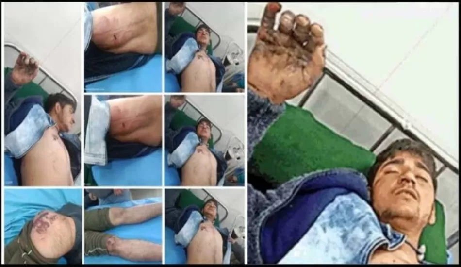 उत्तराखंड में शर्मनाक घटना, मंदिर में एंट्री करने पर दलित युवक को कोयले से दागकर बुरी तरह पीटा