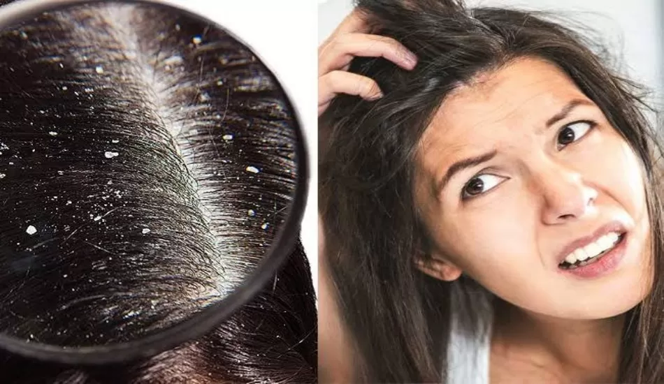 ऑयली स्कैल्प की समस्या से हैं परेशान... तो आज ही अपनाएं ये TIPS...