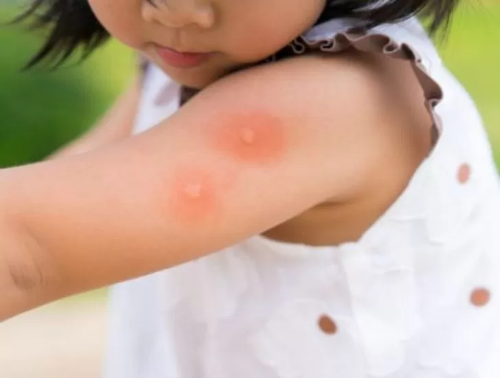 नहीं थम रहा डेंगू का प्रकोप...ऐसे रखें बच्चों का ख्याल